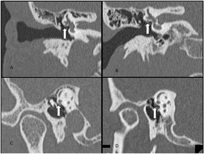 Description of a New Labyrinthine Dehiscence: Horizontal Semicircular Canal Dehiscence at the Tympanic Segment of the Facial Nerve